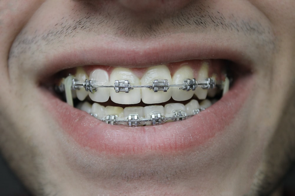 Closeup of a Smiling Man with Braces