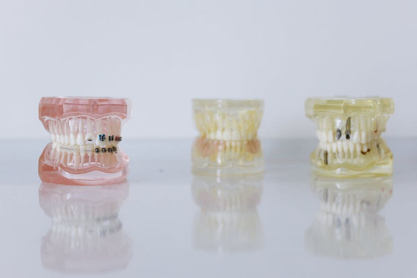 Three Jaw Models Showing Teeth with Braces, Dental Implants, and Normal Teeth